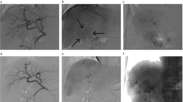 Figure 1 - a-f: cTACE standardization. Selective angiography of the common hepatic artery (a, b) depicts a hypervascular lesion nourished by distal branches of the hepatic artery (arrows)