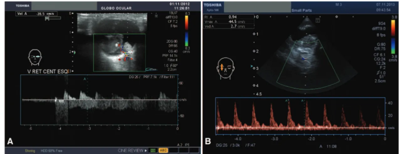 Figure 1 - Color Doppler image coupled with a 16 MHz ultrasonography image of a unilateral retinoblastoma