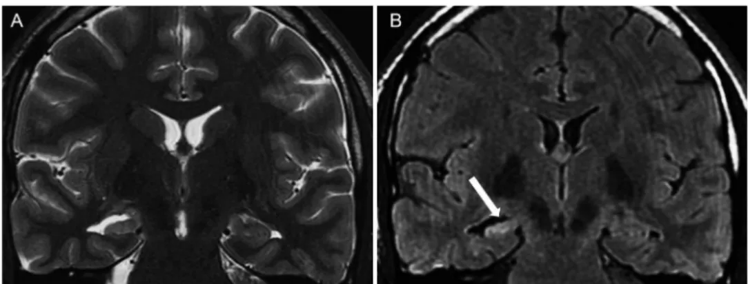 Figure 1 - Hippocampal sclerosis in a 31-year-old man with refractory right mesial temporal sclerosis