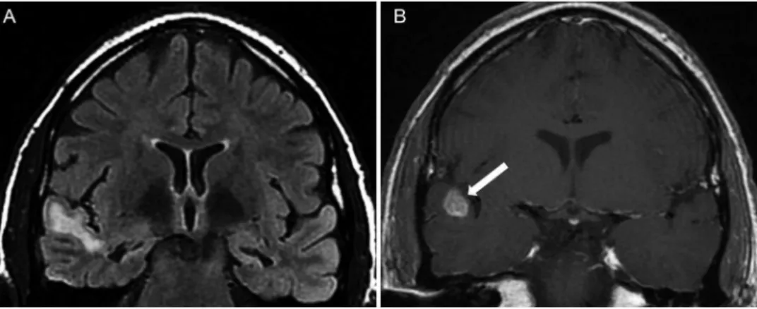 Figure 3 - A typical MRI of focal transmantle cortical dysplasia in a 34-year-old woman