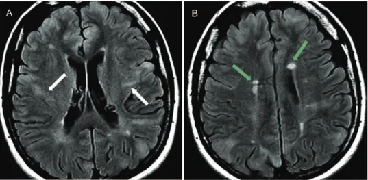 Figure 5 - Tuberous sclerosis in a 21-year-old female with drug-resistant partial epilepsy