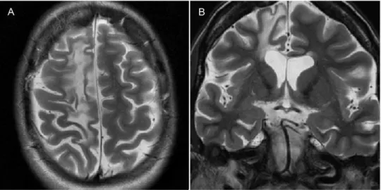 Figure 9 - Sturge-Weber syndrome in a 14-year-old boy with multiple epileptic foci in the right cerebral hemisphere (video-EEG) and chronic partial epilepsy