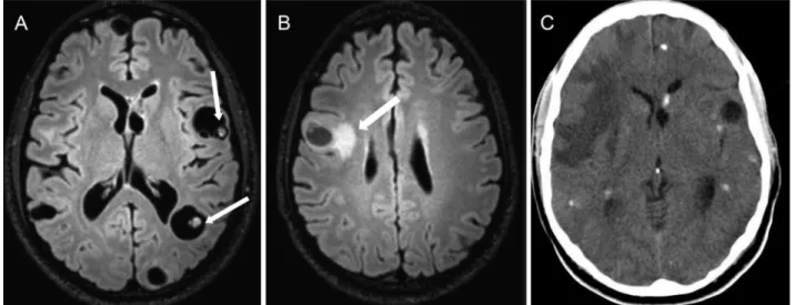 Figure 10 - Disseminated parenchymal neurocysticercosis in a 23-year-old man with intractable epilepsy and multiple epileptic foci (video-EEG)