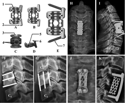 Figure 1 - The ADVS is made of a titanium alloy (Ti6Al4V), which has three major parts, two discs and a vertebra
