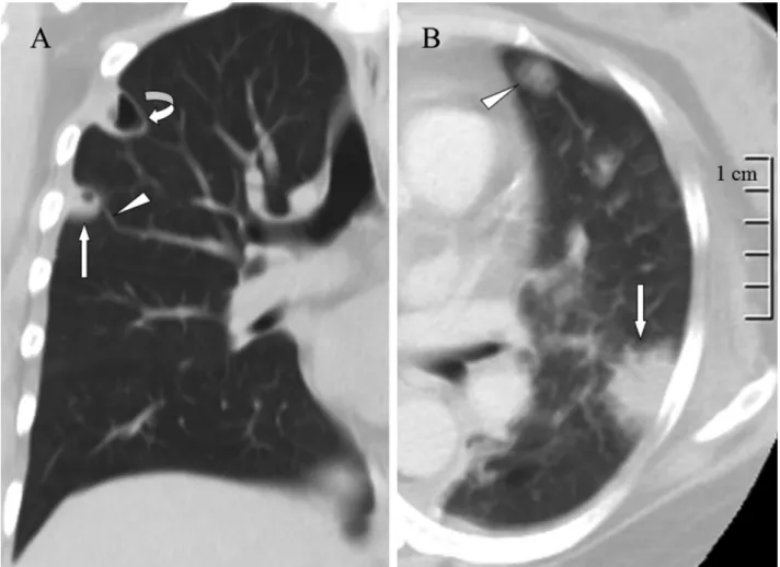 Figure 1 - A) A lung window of a coronal computed tomography scan shows a cavitary nodule (arrow) with a feeding vessel sign (arrowhead) and lung abscess (curved arrow) in the right upper lobe