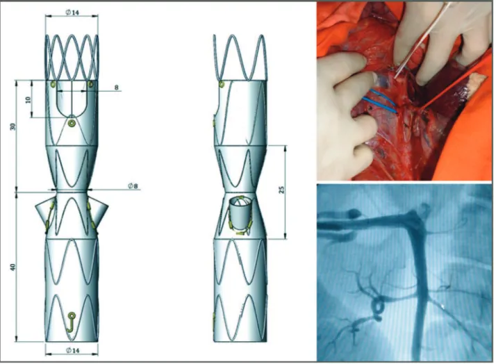 Figure 4 - Hourglass endograft adapted for placement in the porcine model of juxtarenal aneurysm (left) and images of an aortography in one pig (right).