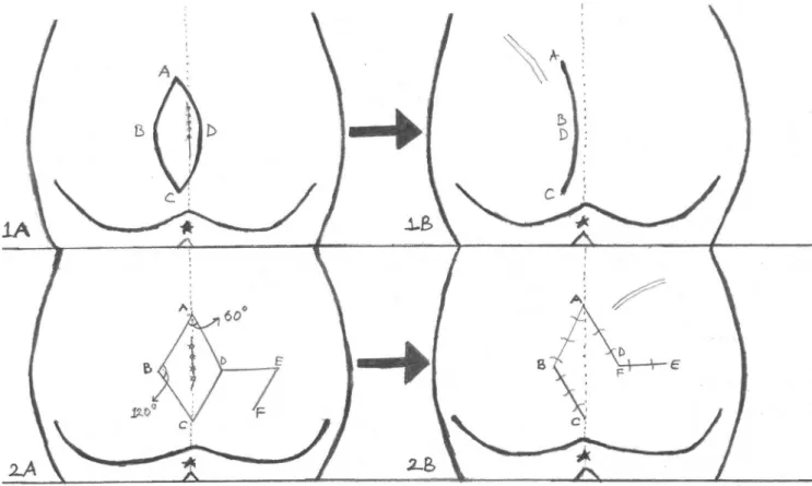 Figure 1 - Asymmetric elliptical excision (1A). Closure of the cavity with Karydakis flap (1B)
