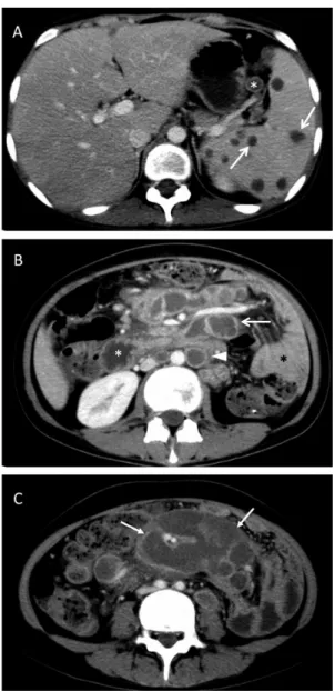 Figure 1 - A 19-year-old female with abdominopelvic and splenic tuberculosis. A: A contrast-enhanced image shows peripheral enhancement of enlarged lymph nodes in the splenic hilum (the lesser omentum; star) and sporadic peripheral enhancement lesions in t