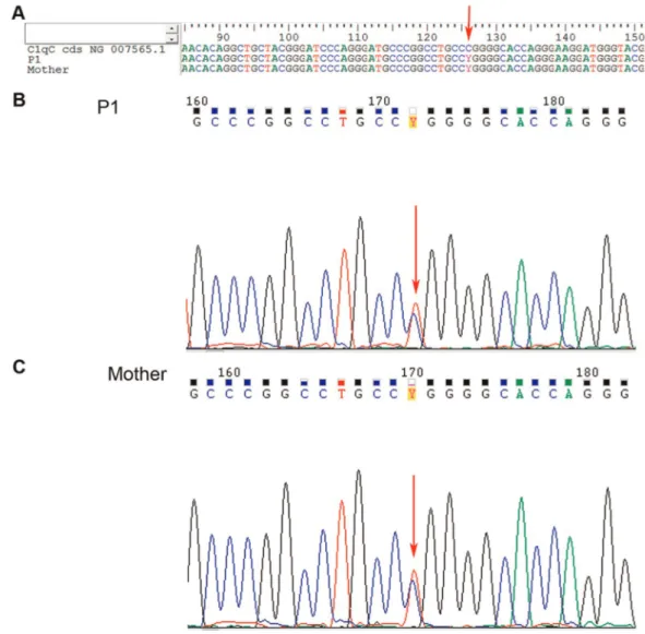 Figure 3 - C1qC gene sequencing from juvenile systemic lupus erythematosus patient 1 (P1) and P1’s mother