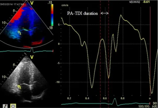Figure 1 - Measurement of the total atrial conduction time (PA-TDI interval). The PA-TDI interval was defined as the time interval between the onset of the P-wave on the surface ECG and the peak Am wave on the tissue Doppler tracing