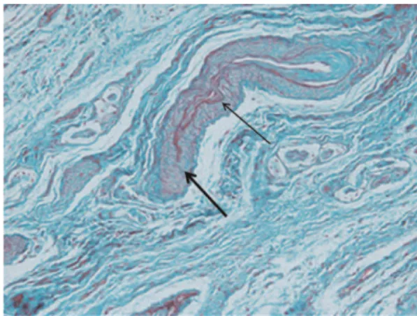 Figure 3 - Gomori trichrome stain (40 6 magnification).