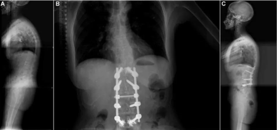 Figure 4 - A: A 54-year-old female patient who had a history of back pain for more than five years