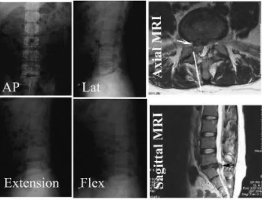 Figure 2 - The technical note for repeated microendoscopic discectomy for recurrent lumbar disc herniation is displayed using a schematic diagram