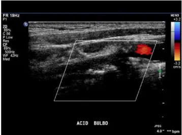 Figure 1 - Color Doppler ultrasound demonstrating the absence of flow in the internal carotid artery (ICA).