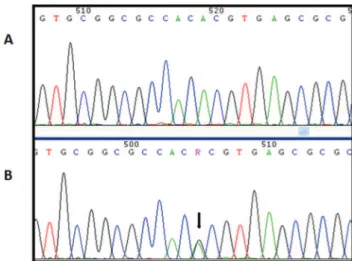 Figure 2 - A, Electropherogram of a patient with wild type NANOS3. B, Electropherogram of a patient with the  hetero-zygous rs2016163 (c.354A4G) variant, indicated by a black arrow.