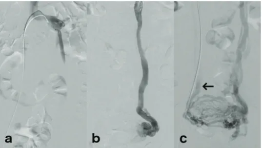 Figure 1 - Venography of three different patients, exemplifying reflux grades. (a) Selective left renal venography shows confined reflux in the left ovarian vein corresponding to grade I reflux