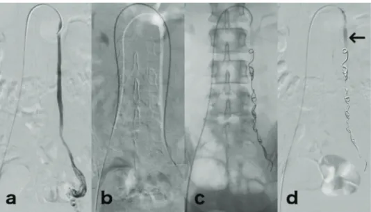 Figure 2 - Embolization technique. (a) Venography pre-embolization with reflux in the left ovarian vein to periuterine veins