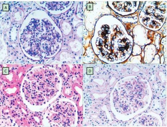 Figure 1 - Histopathology of kidney biopsies. Figure 1A and 1B: A typical representation of DEP-HSPN characterized by significant endothelial proliferation