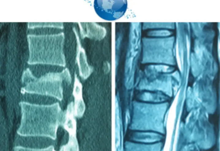 Figure 3 - 44-year-old woman with an A3.2 fracture at level L1. T2WI magnetic resonance image shows that the upper intervertebral disc is injured at a Grade 3 level and that the lower disc is a Grade 2 injury.
