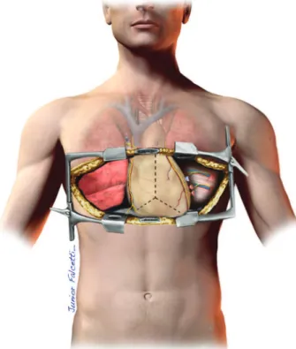 Figure 1 - Left view of the chest cavity from the ‘‘clamshell’’