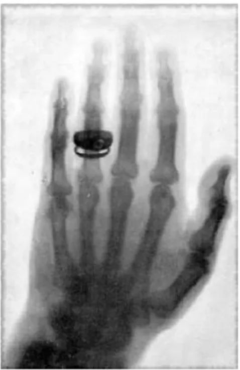 Figura 1. Radiografia de mão de Albert von Kölliker.  Fonte: ASSMUS, A., 1995, p. 15. 