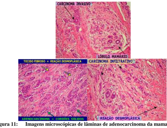 Figura 11:  Imagens microscópicas de lâminas de adenocarcinoma da mama.                          As setas    identificam as alterações encontradas
