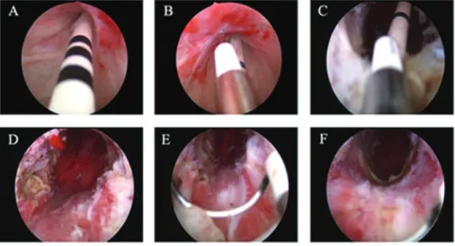Figure 1 - Treatment of posterior urethral stricture using bipolar energy administered via a combination of plasma-cutting and plasma- plasma-loop electrodes