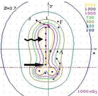 Figure 5 - Isodose contour showing that the ratio of the dose applied to the cervix to the dose applied to the vaginal fornix was 1.0:(1.2–1.4) in stage II patients