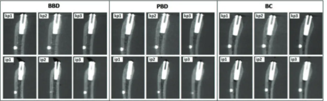 Figure 2 - Image results from the BBD, PBD, and BC cases for the different image acquisition protocols from sagittal CBCT images.