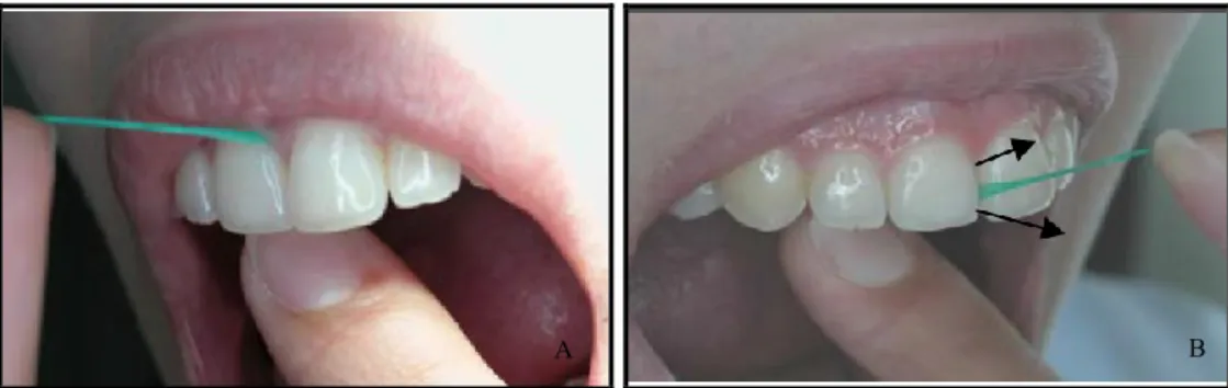 Figura 3 – Como se usa o fio dentário. Fonte: DGS, Divisão de saúde escolar 