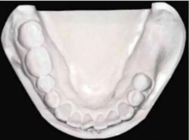 Ilustração  2  -  Prótese  dentária  classe  II  de  Kennedy 