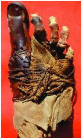 FIG 3.1. Pé de uma múmia de 3000 anos mostrando uso de “biomaterial”, neste caso o  material utilizado foi madeira