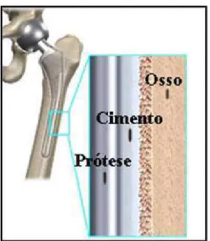 Figura 3.2: Ilustração da posição da prótese, cimento ósseo e o osso em uma  substituição de quadril (Adaptado de OKTAR et al., 2006)