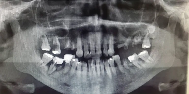 Figura 13- Ortopantomografia.