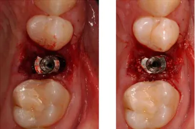 Figura 8 - Instalação de implante imediatamente após exodontia (Tipo 1) com a presença de espaço 