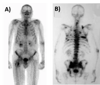Figure 1.2 – Scintigraphy images using  99 Tc from two patients with multiple bone metastasis