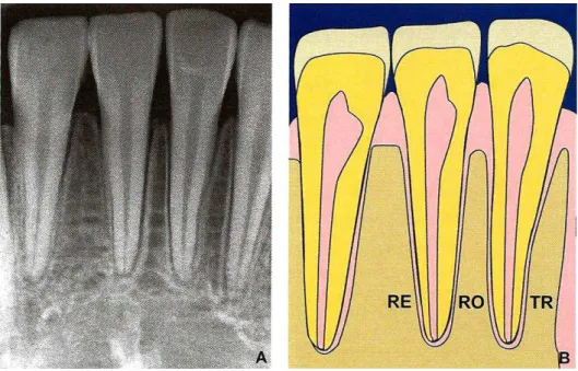 Figura 6:  Classificação  da  morfologia  da  crista  óssea:  retangular  (RE);  romboide  (RO);  triangular (TR)