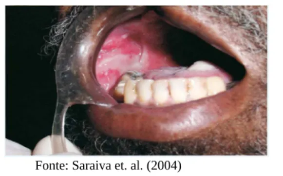 Figura   6:  Mucosite   oral   aguda 