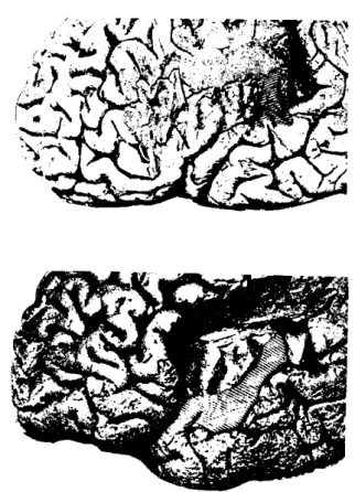 Figura 7: Plasticidade do córtex auditivo de um não músico (7a-figura superior) com a  de um músico (7b-figura inferior) (Critchley e Henson, 1977, p