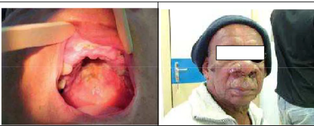 Figura 7 –  Forma mucocutânea. À esquerda: Forma mucosa tardia - lesão ulcerada do palato  mole, com bordas infiltradas recoberta por exsudato