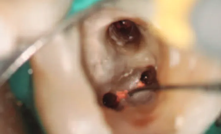 Figure 1 – Identification of the middle mesial canal on the retreatment of tooth #47.