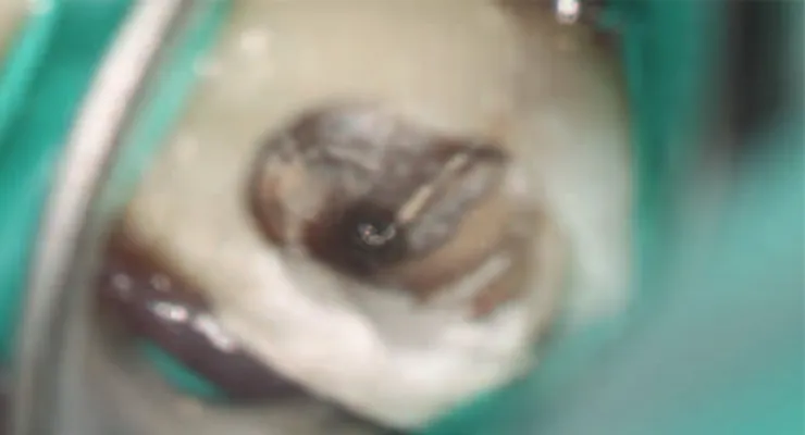 Figure 4 – Visualization of a separated instrument deep in the canal of a molar.
