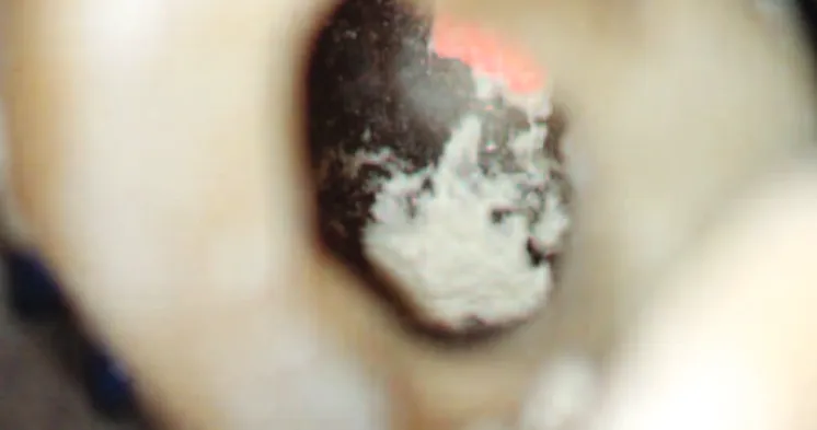 Figure 6 – Repair of the perforation of the case of the Figure 5.