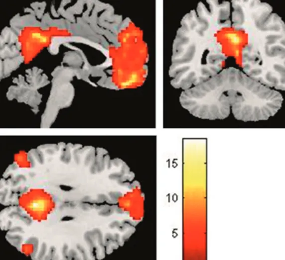 Figure 1. The DMN identifi  ed in the resting state condition at the group level (p &lt; .05, FWE corrected)
