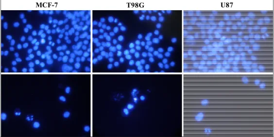 Figura 3.3.3. Fotografia obtida em microscópio de fluorescência de células MCF-7, T98G e U87 controle  (acima) e tratadas com 2 (abaixo) na presença do marcador DAPI