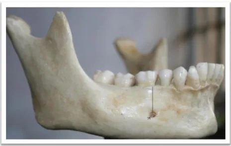 Figura 8 – Buraco mentoniano em relação com o 1º molar. Fonte: Budhiraja V, Rastogi R, Lalwani R,  Goel P, Bose S
