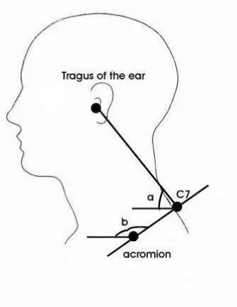 FIGURE 4 – Anteriorization of head  and protrusion of shoulders. 