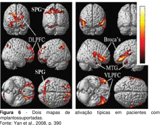 Figura  6  -  Dois  mapas  de  ativação  típicas  em  pacientes  com  próteses 