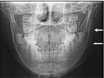 FIGURA 4:  Radiografia  póstero-anterior  de  mandíbula  que  mostra  a  periostite 