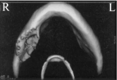 FIGURA 11:  Imagem  3D  da  mandíbula,  obtida  por  TC,  que  mostra  o  crescimento  e  reabsorção do osso na região submandibular, lado direito
